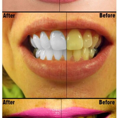 Teeth Whitening PS Action Photo Effects