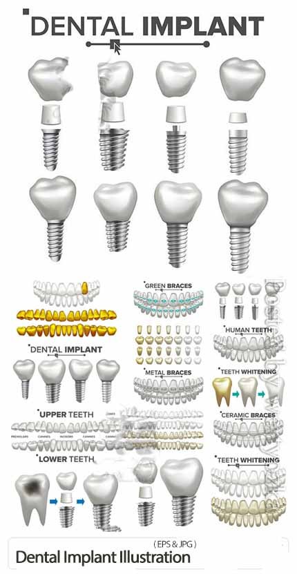 Dental Implant Illustration Vector Set Dental Implant Illustration Vector Set